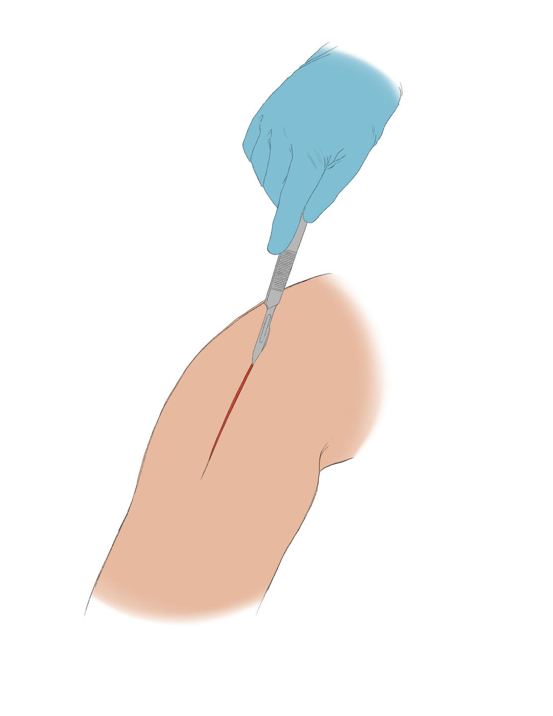 Incision - Knee Surgery - Digital