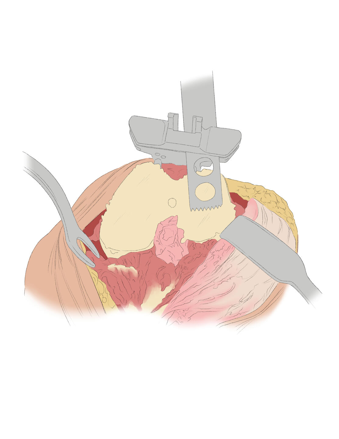 Trimming - Knee Surgery - Digital