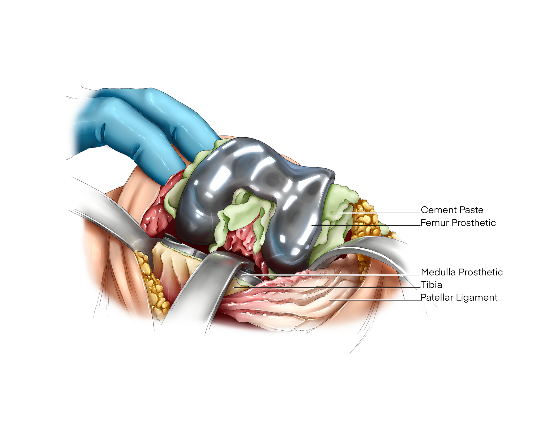 Prosthesis Fitting - Knee Surgery - Digital