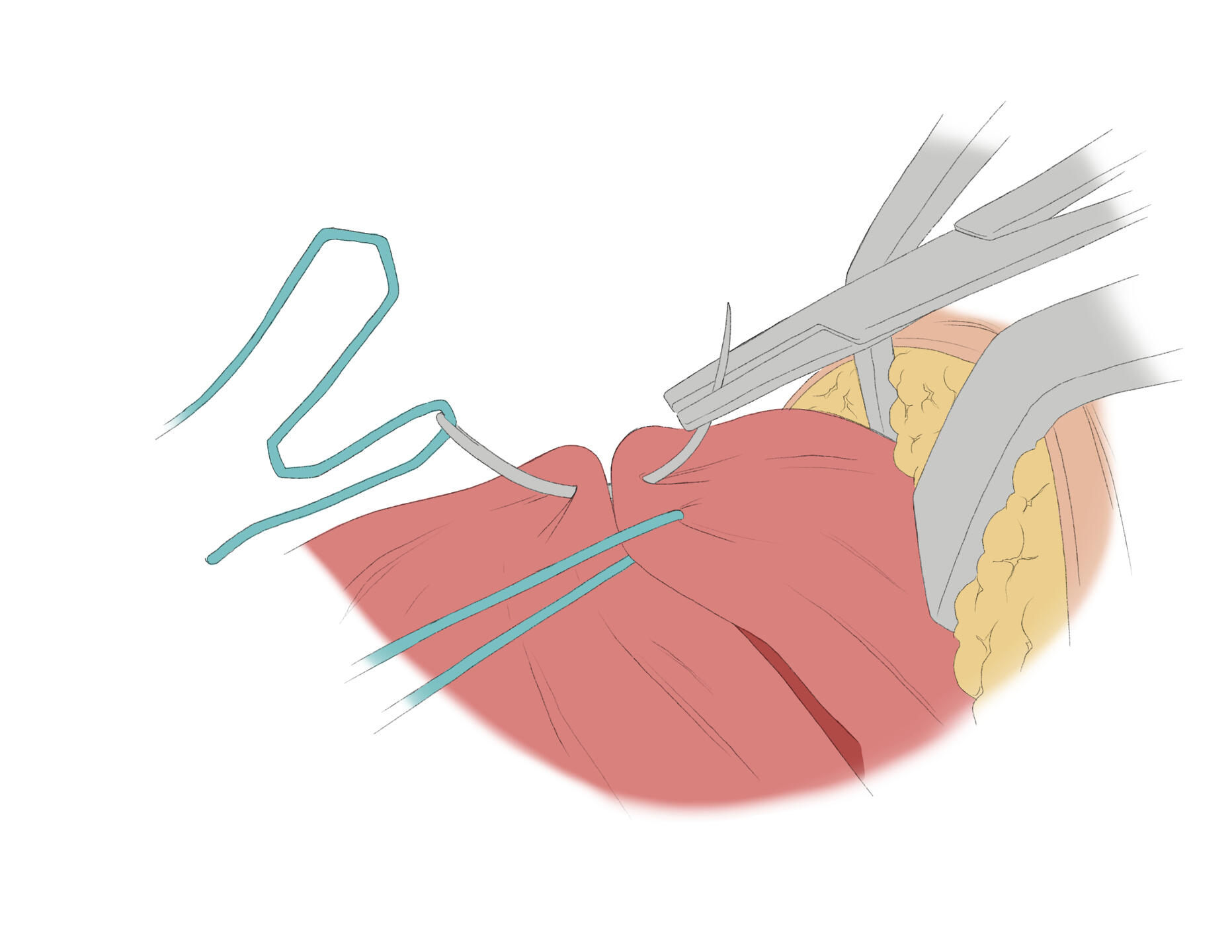 Stitching - Knee Surgery - Digital